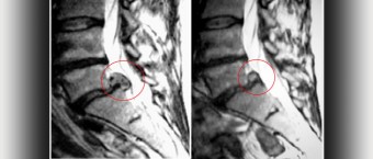 Εικόνα κήλης μεσοσπονδύλιου δίσκου